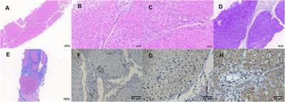 TMEM199-Congenital Disorder of Glycosylation With Novel Phenotype and Genotype in a Chinese Boy